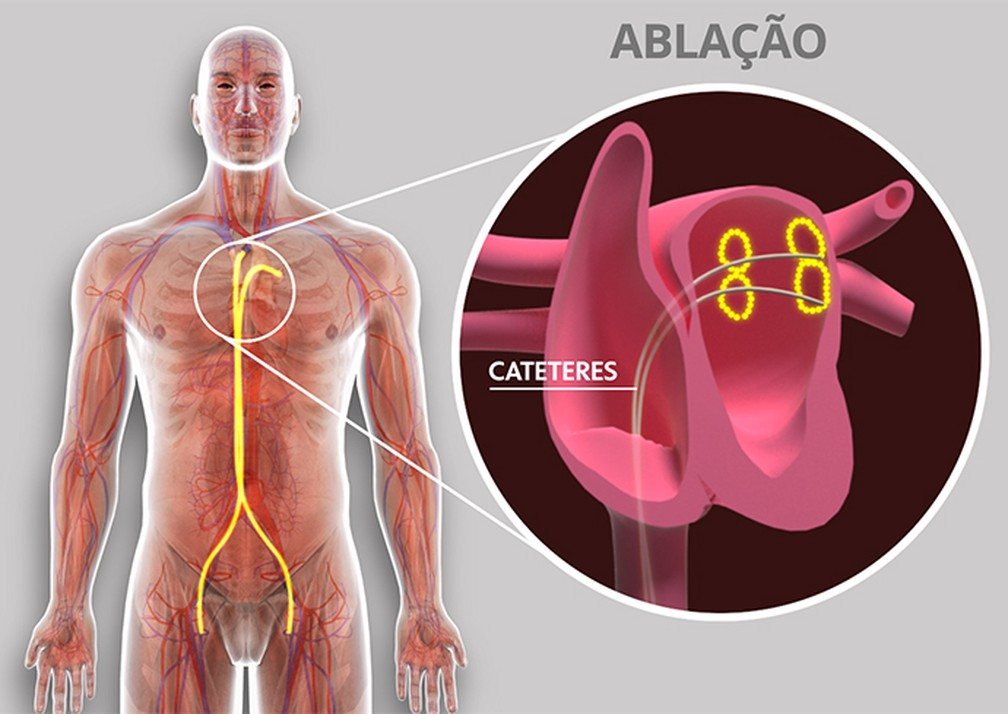 Ablação